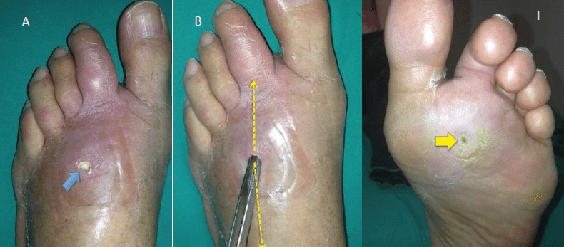 Διαβητικό πόδι με έλκος (μπλέ βέλος)βέλος και επικείμενη επιμόλυνση